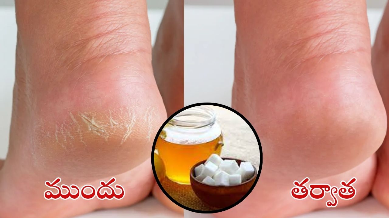 Cracked Heels: కాళ్ల పగుళ్లు వెంటనే తగ్గాలంటే.. కర్పూరంలో ఇవి కలిపి వాడండి