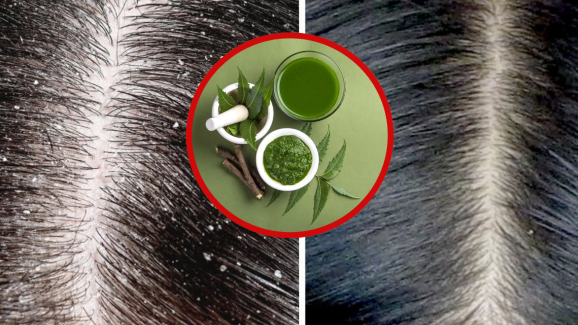 Dandruff: ఇలా చేస్తే.. వారం రోజుల్లోనే చుండ్రు మాయం