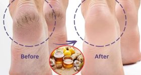Cracked Heels: ఇలా చేస్తే.. కాళ్ల పగుళ్లు త్వరగా తగ్గిపోతాయ్