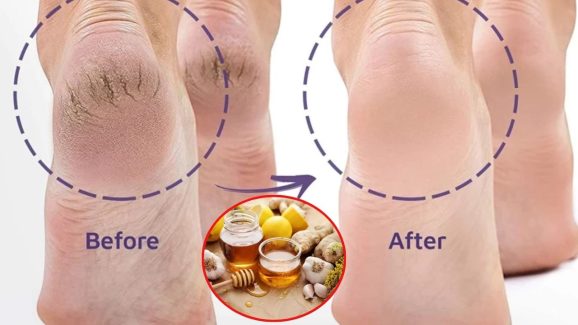 Cracked Heels: ఇలా చేస్తే.. కాళ్ల పగుళ్లు త్వరగా తగ్గిపోతాయ్