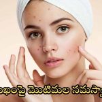 Tips For Pimple Problem: ఇవి వాడితే.. మొటిమలు రమ్మన్నా రావు