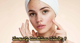 Tips For Pimple Problem: ఇవి వాడితే.. మొటిమలు రమ్మన్నా రావు