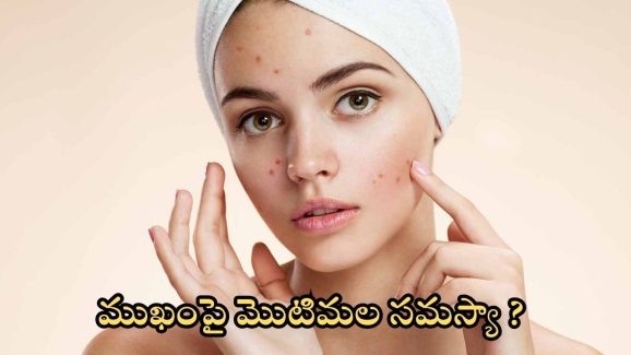 Tips For Pimple Problem: ఇవి వాడితే.. మొటిమలు రమ్మన్నా రావు
