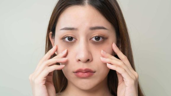 Dark Circles: డార్క్ సర్కిల్స్ తగ్గించే.. బెస్ట్ టిప్స్