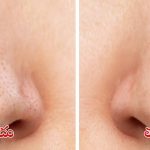 Blackheads: బ్లాక్ హెడ్స్ తగ్గించే.. బెస్ట్ టిప్స్