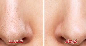 Blackheads: బ్లాక్ హెడ్స్ తగ్గించే.. బెస్ట్ టిప్స్
