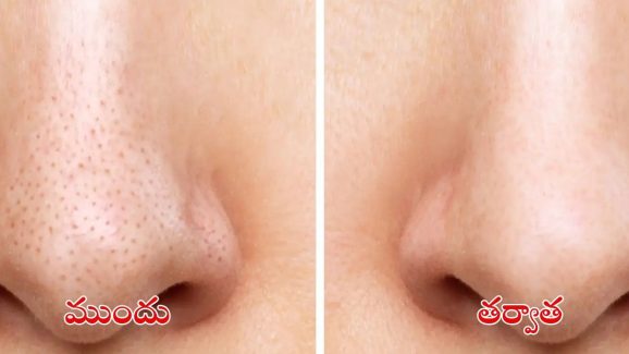 Blackheads: బ్లాక్ హెడ్స్ తగ్గించే.. బెస్ట్ టిప్స్