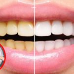 Teeth Whitening Tips: ఇలా చేస్తే.. గార పట్టిన పళ్లు క్షణాల్లోనే.. తెల్లగా మెరిసిపోతాయ్