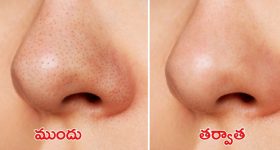 Blackheads: ఇంట్లోనే బ్లాక్ హెడ్స్‌కు చెక్ పెట్టండిలా !