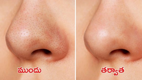 Blackheads: ఇంట్లోనే బ్లాక్ హెడ్స్‌కు చెక్ పెట్టండిలా !