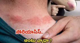 Psoriasis: సోరియాసిస్ ఎందుకు వస్తుంది ? ఇది అంటు వ్యాధా ?