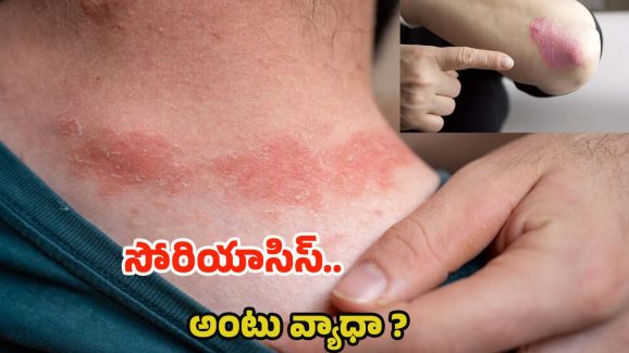Psoriasis: సోరియాసిస్ ఎందుకు వస్తుంది ? ఇది అంటు వ్యాధా ?