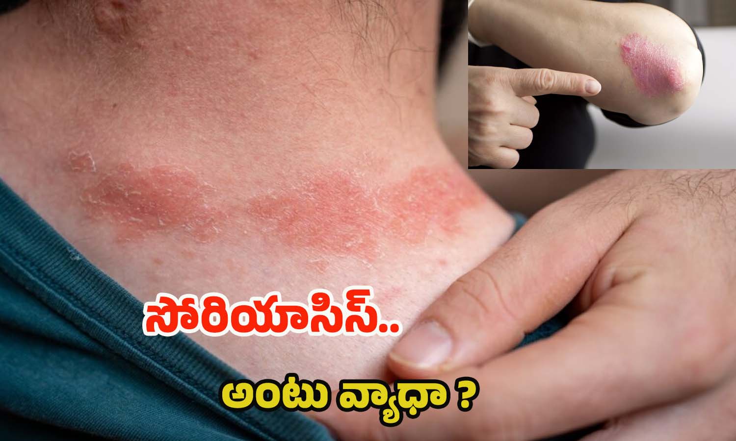 Psoriasis: సోరియాసిస్ ఎందుకు వస్తుంది ? ఇది అంటు వ్యాధా ?