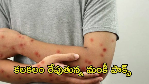 Monkeypox: కలకలం రేపుతున్న మంకీ పాక్స్.. ఈ ఏడాది తొలి కేసు నమోదు, ఎక్కడంటే ?