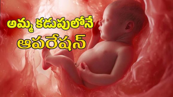 Baby heart surgery : చిన్నారి గుండెకు అరుదైన శస్త్ర చికిత్స.. హైదరాబాద్ వైద్యుల ఘనత..