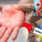 Telangana Gullian Barre Syndrome: తెలంగాణలో ప్రాణాంతక జిబిఎస్ వ్యాధి.. హైదరాబాద్‌లో తొలి కేసు నమోదు