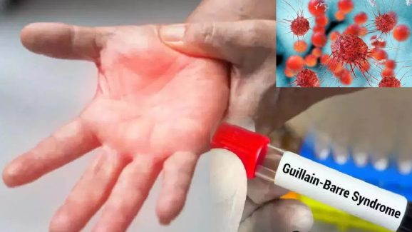 Telangana Gullian Barre Syndrome: తెలంగాణలో ప్రాణాంతక జిబిఎస్ వ్యాధి.. హైదరాబాద్‌లో తొలి కేసు నమోదు