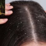 Olive Oil For Dandruff: చుండ్రు సమస్యకు ఈ ఆయిల్‌తో.. శాశ్వత పరిష్కారం