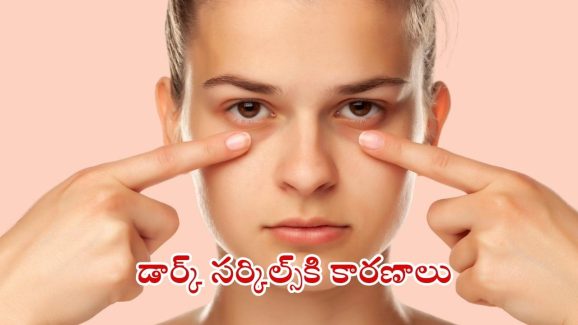 Dark Circles: డార్క్ సర్కిల్స్ రావడానికి గల కారణాలివే !