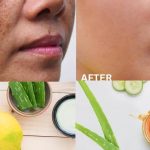 Pigmentation: ఇలా చేస్తే.. ముఖంపై మంగు మచ్చలు పూర్తిగా మాయం