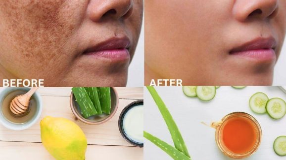 Pigmentation: ఇలా చేస్తే.. ముఖంపై మంగు మచ్చలు పూర్తిగా మాయం