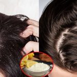 Tips For Dandruff: చుండ్రు శాశ్వతంగా తగ్గాలంటే.. ఈ ఒక్కటి వాడితే చాలు