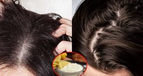 Tips For Dandruff: చుండ్రు శాశ్వతంగా తగ్గాలంటే.. ఈ ఒక్కటి వాడితే చాలు