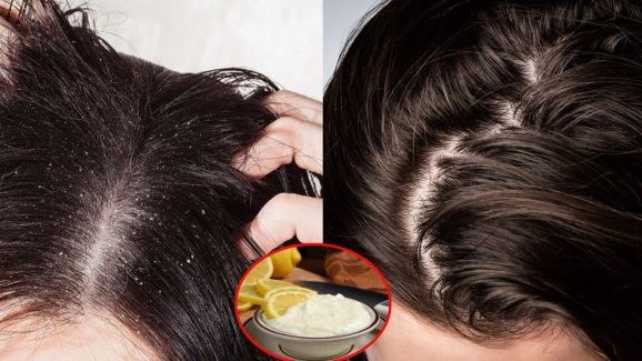 Tips For Dandruff: చుండ్రు శాశ్వతంగా తగ్గాలంటే.. ఈ ఒక్కటి వాడితే చాలు