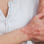 Psoriasis: సోరియాసిస్ అంటు వ్యాధా? అది ఒకరి నుంచి మరొకరికి సోకుతుందా?