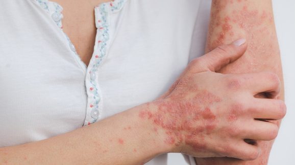 Psoriasis: సోరియాసిస్ అంటు వ్యాధా? అది ఒకరి నుంచి మరొకరికి సోకుతుందా?