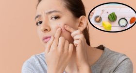 Acne Problem: వీటితో.. మొటిమలకు శాశ్వత పరిష్కారం !