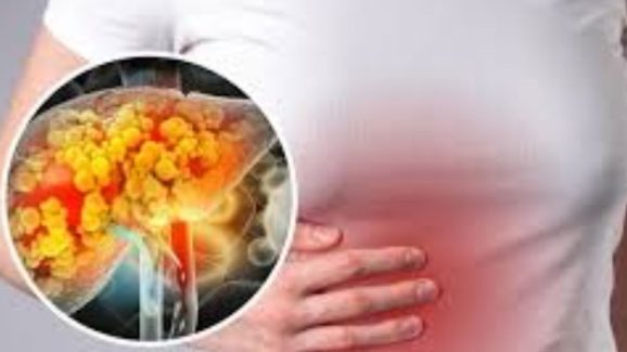 Fatty Liver Symptoms: మీలో ఈ లక్షణాలు ఉన్నాయా ? ఫ్యాటీ లివర్ కావొచ్చు.. జాగ్రత్త !
