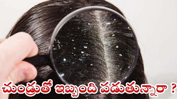 Dandruff: వీటిని ఒక్కసారి వాడితే.. చుండ్రు అస్సలు రాదు