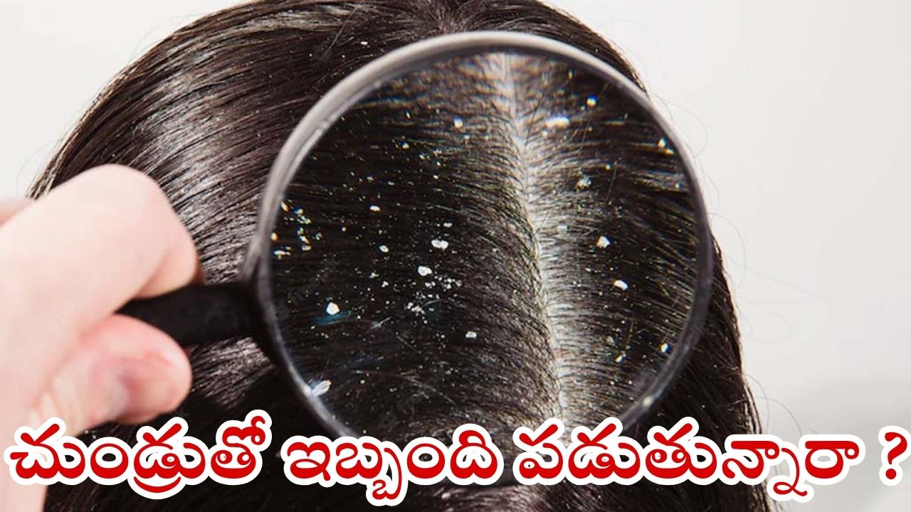 Dandruff: వీటిని ఒక్కసారి వాడితే.. చుండ్రు అస్సలు రాదు