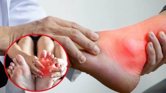 Uric Acid: శరీరంలో యూరిక్ యాసిడ్ పెరిగితే.. ఈ లక్షణాలు కనిపిస్తాయ్