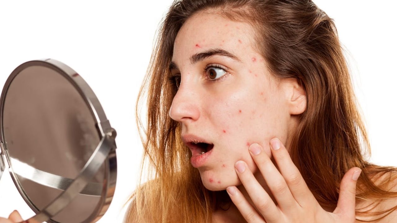 Pimple: ముఖంపై మొటిమలా ? ఇలా చేస్తే ప్రాబ్లమ్ సాల్వ్