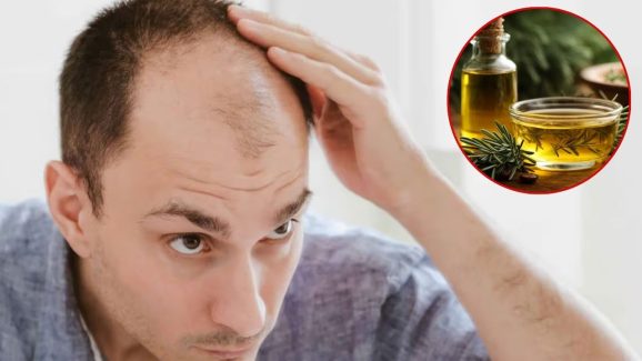 Bald Head: ఆముదంలో ఈ ఒక్కటి కలిపి వాడితే.. జన్మలో బట్ట తల రాదు