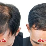 Hair Fall Control Tips: ఇలా చేస్తే.. బట్టతల జన్మలో రాదు