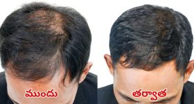 Hair Fall Control Tips: ఇలా చేస్తే.. బట్టతల జన్మలో రాదు