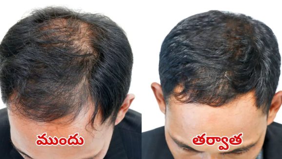 Hair Fall Control Tips: ఇలా చేస్తే.. బట్టతల జన్మలో రాదు