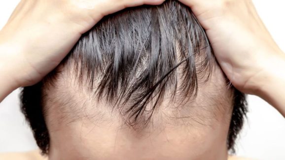 Hair Fall: విపరీతంగా జుట్టు రాలుతోందా ? ఈ టిప్స్ మీ కోసమే !