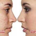 Pimple Marks: వీటిని ఒక్కసారి వాడినా చాలు, ముఖంపై మచ్చలు మాయం