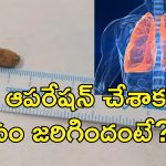Pencap Removed Lungs 21 Years : పెన్ క్యాప్ మింగేసిన 5 ఏళ్ల బాలుడు.. 21 ఏళ్ల తరువాత ఆపరేషన్ చేస్తే..