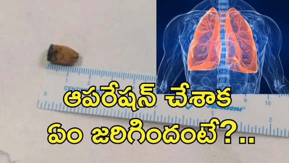 Pencap Removed Lungs 21 Years : పెన్ క్యాప్ మింగేసిన 5 ఏళ్ల బాలుడు.. 21 ఏళ్ల తరువాత ఆపరేషన్ చేస్తే..