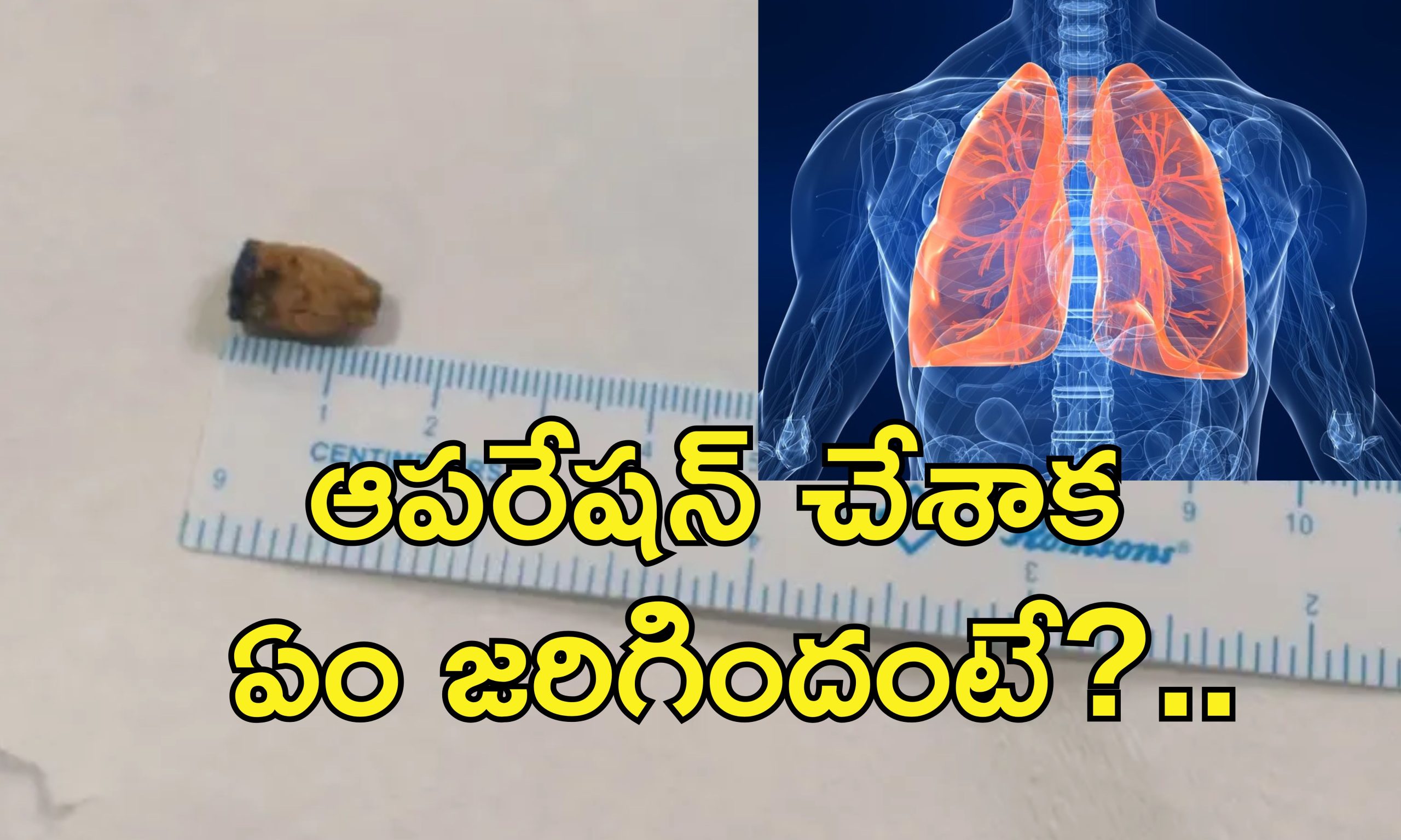 Pencap Removed Lungs 21 Years : పెన్ క్యాప్ మింగేసిన 5 ఏళ్ల బాలుడు.. 21 ఏళ్ల తరువాత ఆపరేషన్ చేస్తే..