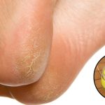 Cracked Heels: కాళ్ల పగుళ్లు తగ్గాలంటే.. ఇలా చేయండి చాలు !