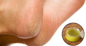Cracked Heels: కాళ్ల పగుళ్లు తగ్గాలంటే.. ఇలా చేయండి చాలు !