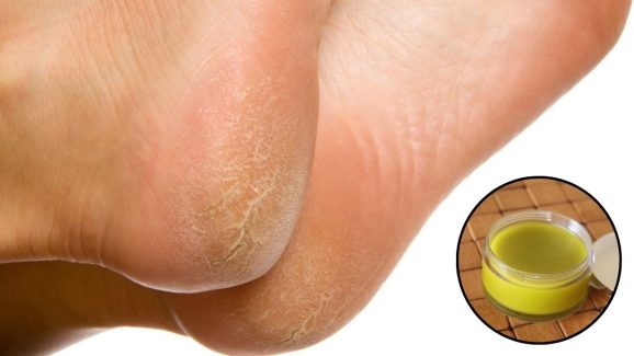 Cracked Heels: కాళ్ల పగుళ్లు తగ్గాలంటే.. ఇలా చేయండి చాలు !