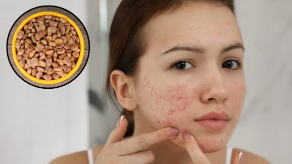 Chironji For Skin: చిరోంజిని ఇలా వాడితే.. ముఖంపై ఒక్క మచ్చ కూడా ఉండదు