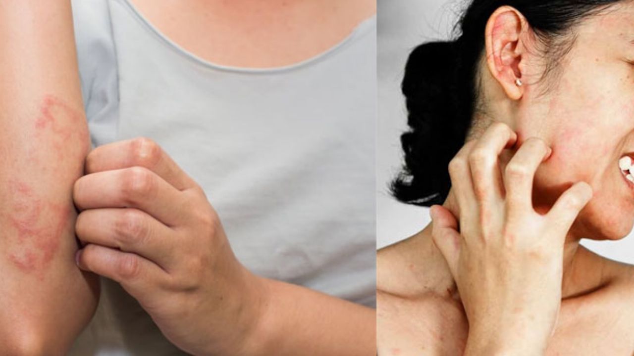Skin Allergy: అలర్జీతో ఇబ్బంది పడుతున్నారా ? ఈ హోం రెమెడీస్ ట్రై చేయండి